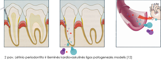 letinio-periodontito-ir-isemines-kardiovaskulines-ligos-patogenezes-modelis